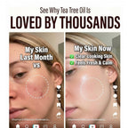 Tea Tree Essential Oil